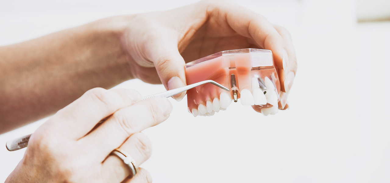 Dental Implants - Douglas M Johnson - Dentist - Oregon